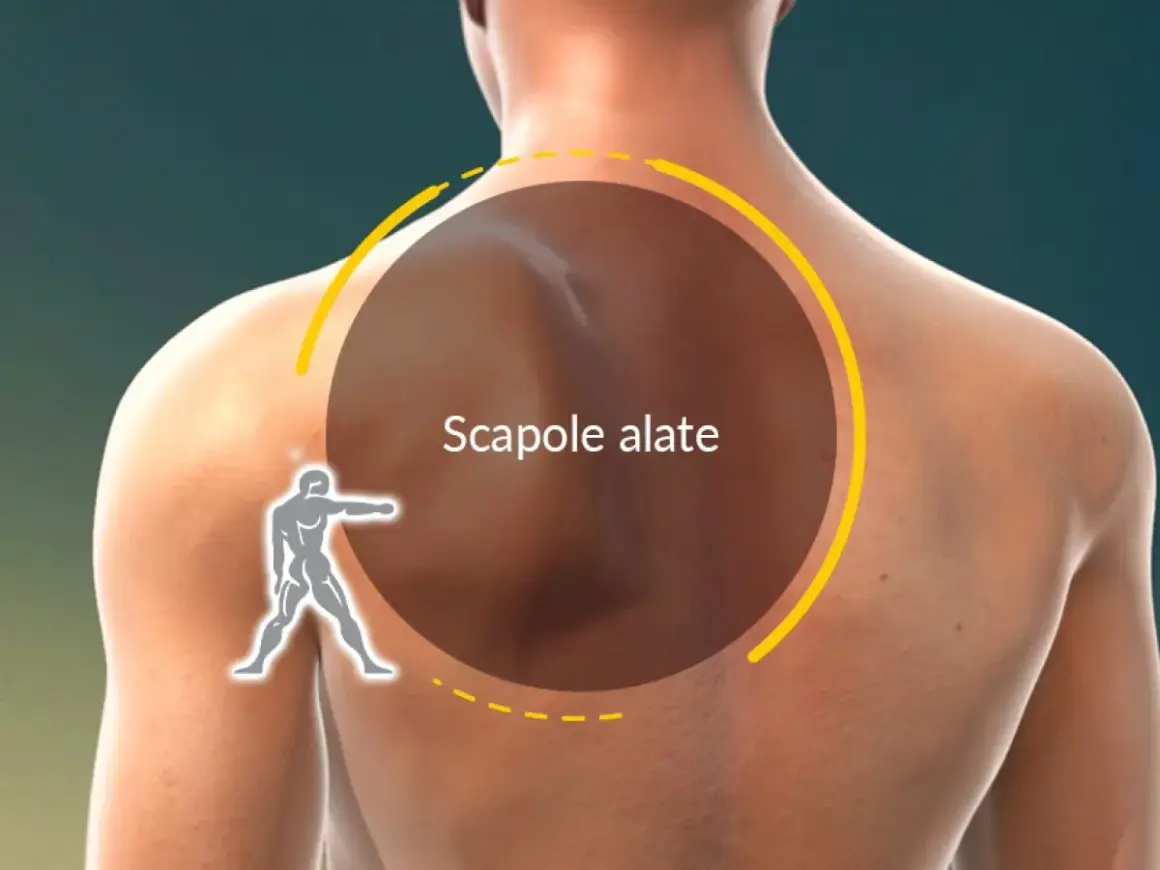 Vista posteriore di un uomo con un cerchio che evidenzia le scapole alate. Un piccolo omino stilizzato indica la zona.
